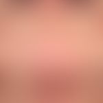 Hautalterung: altersbedingte Involution der Lippen- und Kinnregion

