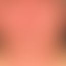 Subakute kontakallergische Dermatitis: unscharf bgrenzte (auslaufende) Rötung und Schuppung des G...