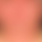 Subakute kontakallergische Dermatitis: unscharf bgrenzte (auslaufende) Rötung und Schuppung des G...