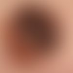 Naevus melanozytärer kongenitaler: seit Geburt bestehender, mitwachsender, seit&nbsp;Jahren völli...