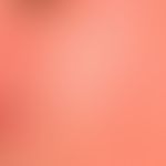 Subakute kontakallergische Dermatitis: unscharf begrenzte (auslaufende) Rötung und (grobe) Schupp...