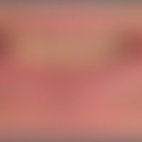 Cheilitis actinica chronica: gleichmäßige, flächige&nbsp; Leukoplakie von Ober-und Unterlippe mit...