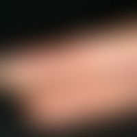 Psoriasis palmaris et plantaris:&nbsp;Trocken-keratotischer Plaque-Typ. Seit mehreren&nbsp; Jahre...