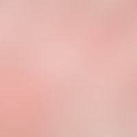 Dermatitis, seborrhoische: Unscharf begrenzte,&nbsp; groblamellär schuppende, flächige, leicht in...
