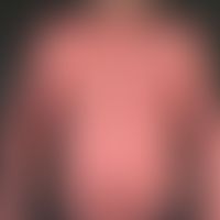 Erythrodermische Mycosis fungoides:&nbsp;erythrodermisches Krankheitsbild&nbsp;mit leukämischem B...