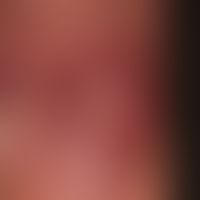 Schwimmbadgranulom: Detailaufnahme.
