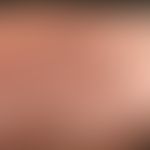 Mucinosis follicularis (Typ II):&nbsp; disseminierte, 0,1 cm große,&nbsp;hautfarbene, auch rote&n...
