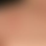 Mucinosis follicularis (Typ II):&nbsp; disseminierte, 0,1 cm große,&nbsp;hautfarbene, auch rote&n...