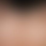 Alopezie postmenopausale, frontale, fibrosierende: gleichmäßiges&nbsp;Zurücktreten der frontalen&...