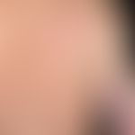 Zoster:&nbsp;seit mehreren Tagen bestehendes, ausgedehntes, teils herpetiform angeordnetes Exanth...