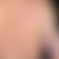 Zoster:&nbsp;seit mehreren Tagen bestehendes, ausgedehntes, teils herpetiform angeordnetes Exanth...