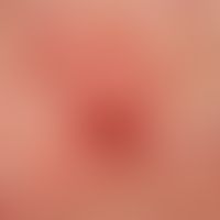 Keratoakanthom klassischer Typ: klassischen Wuchsform des Keratoaktnhoms. Im Zentrum keratotische...