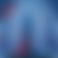 Schematische Darstellung eines Mesothelioms (entnommen aus&nbsp;Milano Finanza)&nbsp;

