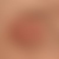 Steatocystoma multiplex: Befall der Areolae mamillae
