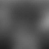 Steatocystoma multiplex hereditäre Form mit Zahnanomalien (Panaorama-Rö.-Aufnahme)&nbsp; (Abbildu...