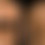 Naevus verrucosus: ausgedehnter bilateraler Naevus verrucosus
