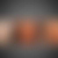 Postsomatische Mosaikdermatose: Hautveränderungen nach den Blaschko-Linien angeordnet.
