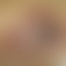 Angiomatose diffuse kutane: rote bizarr begrenzte Plaque mit zentraler Ulzeration (Abb. entnommen...