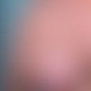 Angiomatose, diffuse, dermale der weiblichen Brust:&nbsp;teils flächige, teils&nbsp;retikuläre Rö...