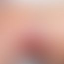 Kaposiformes Hämangioendotheliom: großflächiger&nbsp;vaskulärer Tumor, randständig mit älteren un...