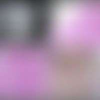 Hämangioendotheliom retiformes: Die Computertomographie zeigt mehrere heterogen verstärkte Weicht...