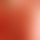 Pilomatrixkarzinom: Frau, 85 Jahre. Der Tumor wurde bioptiert, leider ohne eindeutigen Befund. Au...