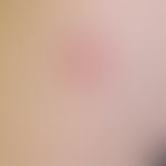 Basalzellkarzinom sklerodermiformes: Frau, 77 Jahre, Oberarm aussenseitig. Sichtbar nur die flach...