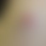 Basalzellkarzinom sklerodermiformes: Frau, 77 Jahre, Oberarm aussenseitig.&nbsp; Durch leichtes S...