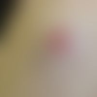 Basalzellkarzinom sklerodermiformes: Frau, 77 Jahre, Oberarm aussenseitig.&nbsp; Durch leichtes S...