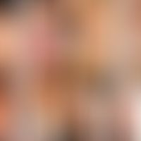 Segmentale Vitiligo: klinischer Verlauf der segmentalen Vitiligo. Entommen aus: Park JH et al. (2...