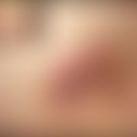 Arzneimittelreaktion fixe: Ciprofloxazin-induziertes fixe Arzneimittelreaktion rechtsseitiger chr...