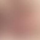 Radiation Recall Dermatitis: dermatitische Reaktion in dem zuvor bestrahlten Hautareal nach Verab...
