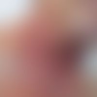 Radiation Recall Dermatitis: dermatitische Reaktion in dem zuvor bestrahlten Hautareal nach Verab...
