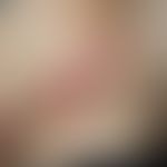 Wolf´s isotopische Antwort: zosteriform angeordnetes bullöses Pemphigoid. Abb. entommen aus:&nbsp...