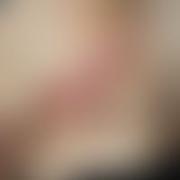 Wolf´s isotopische Antwort: zosteriform angeordnetes bullöses Pemphigoid. Abb. entommen aus:&nbsp...