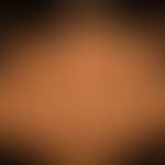 Acanthosis nigricans (benigna): generalisiertes Krankheitsbild mit großflächigen, unscharf begren...