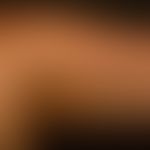 Acanthosis nigricans (benigna): generalisiertes Krankheitsbild mit großflächigen, unscharf begren...