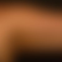 Acanthosis nigricans (benigna): generalisiertes Krankheitsbild mit großflächigen, unscharf begren...