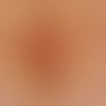 Differenzialdiagnose Acanthosis nigricans:&nbsp;follikuläre braune Ppeln die in körperzentralen A...
