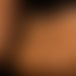 Acanthosis nigricans (benigna): generalisiertes Krankheitsbild mit großflächigen, unscharf begren...