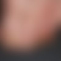 Acrodermatitis continua suppurativa: seit&nbsp;Jahren bestehende, ausgeprägte, lokaltherapeutisch...