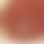 Melanom amelanotisches, Auflichtmikroskopie:&nbsp;unpigmentierter, schuppender Plaque, diskrete P...