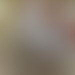 Melanom akrolentiginöses, Auflichtmikroskopie:&nbsp;nach vorsichtigem Entfernen der Hornschicht r...