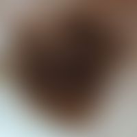 Keratose seborrhoische, Auflichtmikroskopie: sehr dunkel pigmentierter&nbsp; Tumor mit zahlreiche...