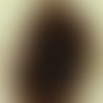Naevus melanozytärer, Junktionstyp, Auflichtmikroskopie
