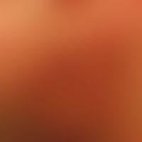 Angiolymphoide Hyperplasie mit Eosinophilie:&nbsp; Mann, 58 Jahre. Bei Erstvorstellung seit ca. 3...