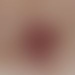 Neurofibrom, pigmentiertes bei peripherer Neurofibromatose, Auflichtmikroskopie
