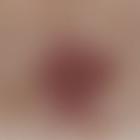Neurofibrom, pigmentiertes bei peripherer Neurofibromatose, Auflichtmikroskopie
