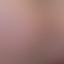 Trichodysplasia&nbsp;spinulosa: akneartiges Krankheitsbild mit kleineren und größeren follikuläre...