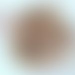 Basalzellkarzinom pigmentiertes, Auflichtmikroskopie, kleiner Tumor am Oberarm, s.a. nachfolgende...